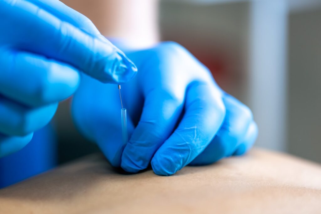 Close up of a needle and hands of physiotherapist doing a dry needling. dry needling